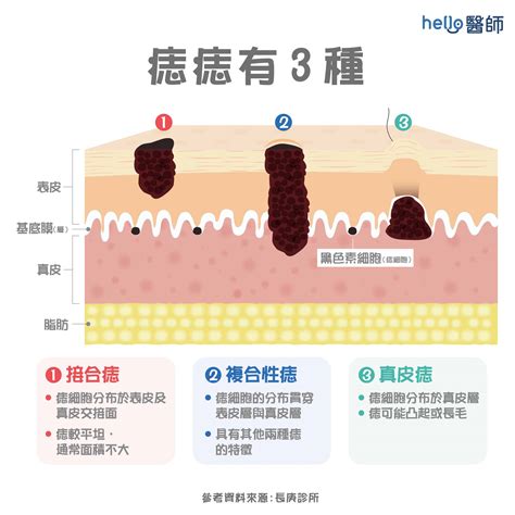 痣的形成原因|為什麼臉上的痣越來越多？皮膚科醫師解析長痣原因、。